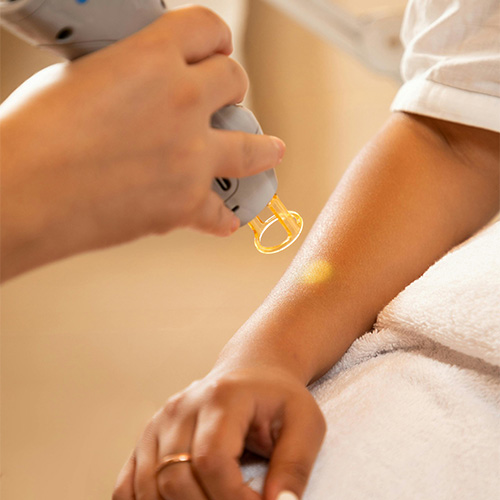 laserhairremoval
